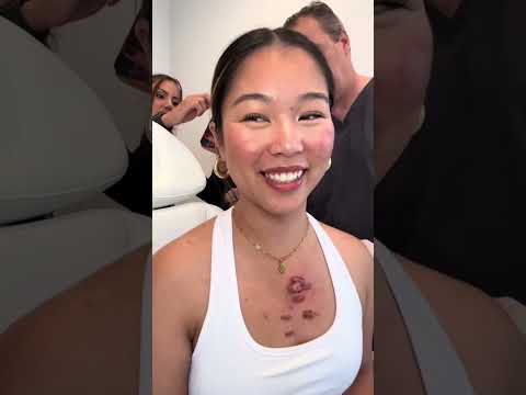 heres how my first appointment went #keloids #keloidtreatment #keloidremoval #kenalog #laser