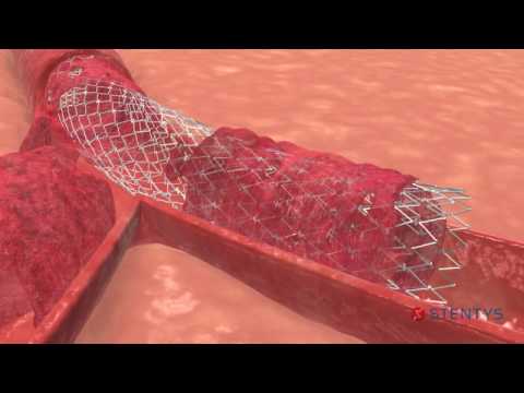 Self-Apposing STENTYS BMS and DES(P) stents for Bifurcation Lesions