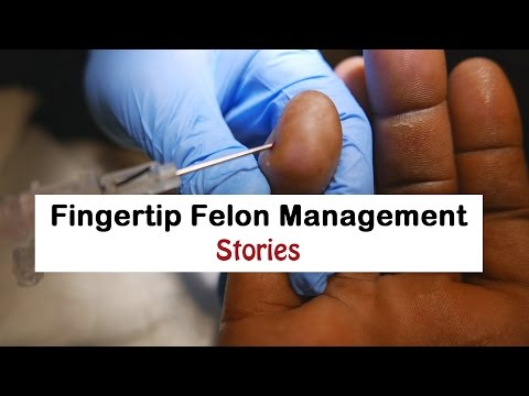 Fingertip Felon Management Stories