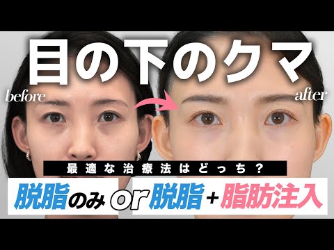 【目の下のクマ取り・脂肪注入】脱脂のみと脱脂＋脂肪注入どっちが良い？手術から半年間のダウンタイムに密着！