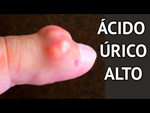 What is gout? – causes, symptoms, diagnosis and treatment- HIGH URIC ACID