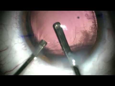 PCCC for Fibrotic Plaque and Residual Silicone Oil Removal (Part 2)