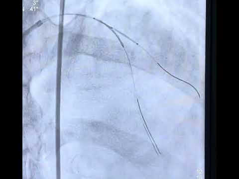 Case 11:-LAD- D1 bifurcation angioplasty,mini crush technique step by step