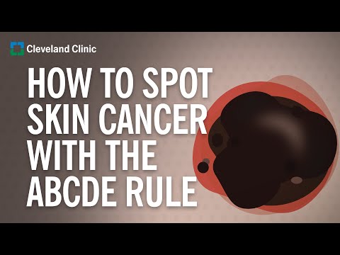 What Does Skin Cancer Look Like?