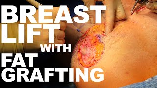 Breast Lift with Fat Grafting - Dr Paul Ruff  West