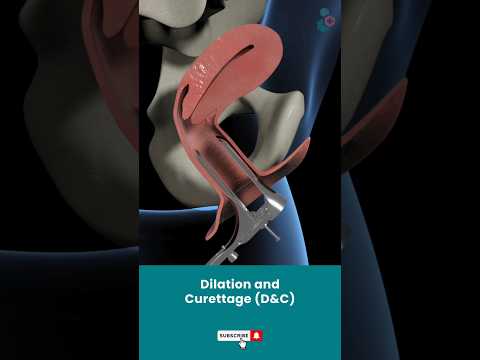 Dilation And Curettage (D&C) | Fertility Treatment ↪3D Medical Animation #Shorts #Dilation&Curettage