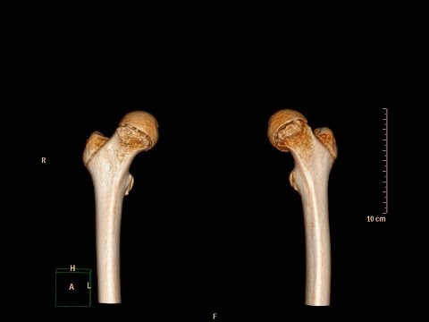 Slipped Capital Femoral Epiphysis