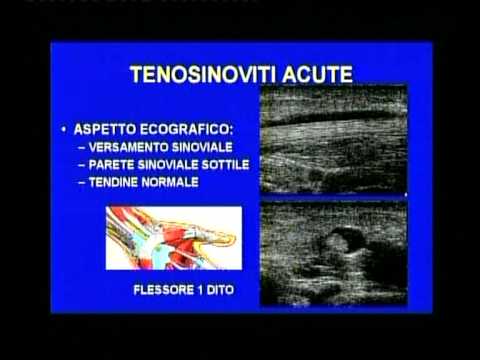 Mal di schiena nelle donne durante la gravidanza a 30 settimane Dopo una frattura del gomito quando si può fare sport