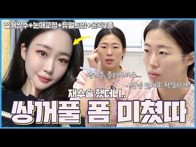 더 예쁘게, 에이비성형외과 이벤트 더 예쁘게, 에이비성형외과 이벤트