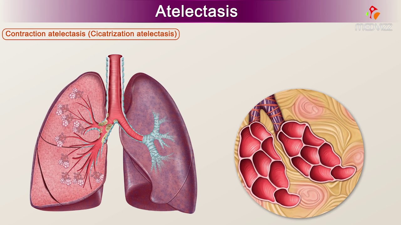 Atelectasis : Etiology, Clinical Features, Pathology, pathophysiology, Diagnosis, and Treatment - YouTube