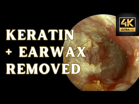 Keratin + Earwax  Removed (4K 60 FPS)