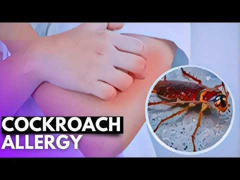 Wheat Allergy Causes Signs and Symptoms Diagnosis and Treatment