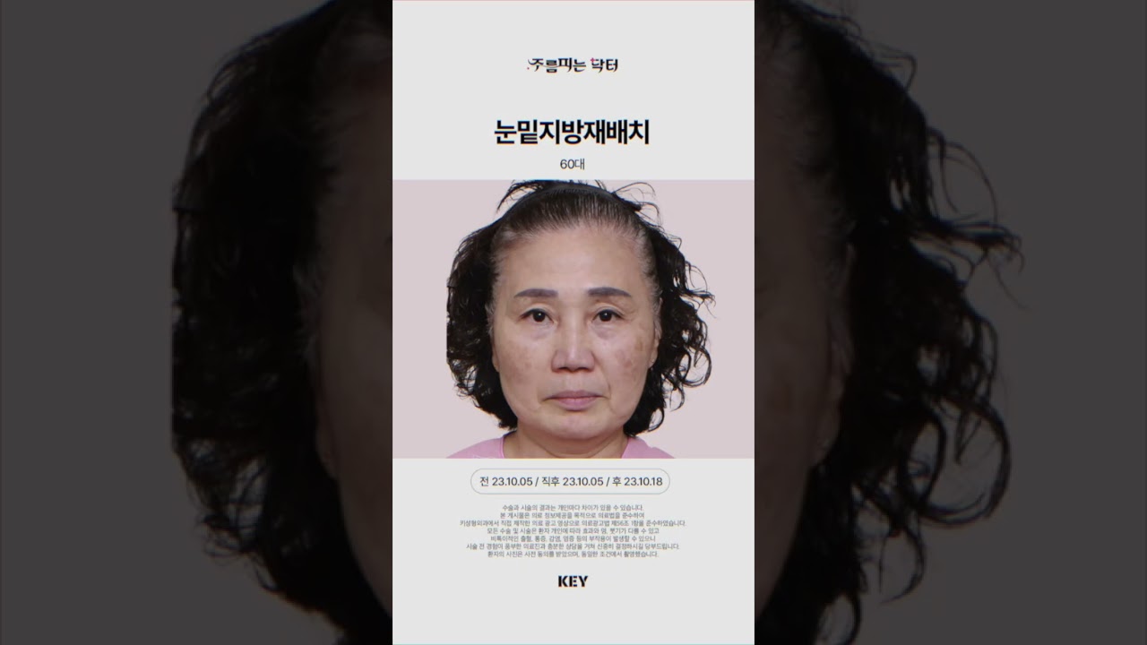 60대 고모에게 직접 해드린 눈밑지방재배치