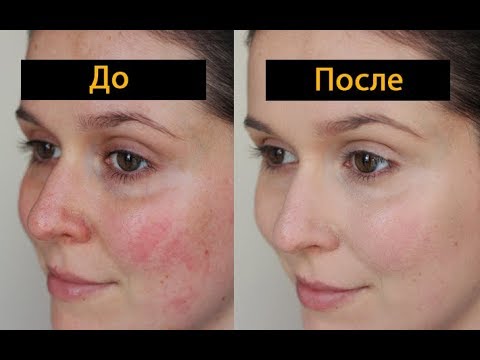 Крем пигментации отзывы Лечение пигментация лица