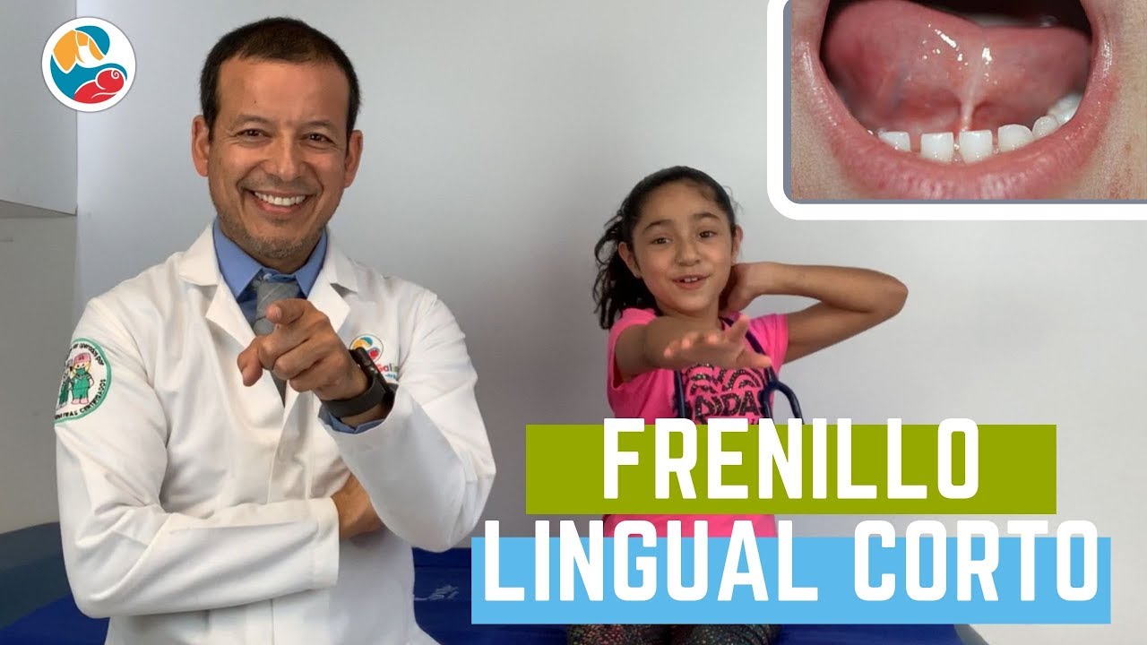FRENILLO LINGUAL CORTO