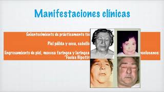 Hipotiroidismo - Dra. Patricia Agüero.