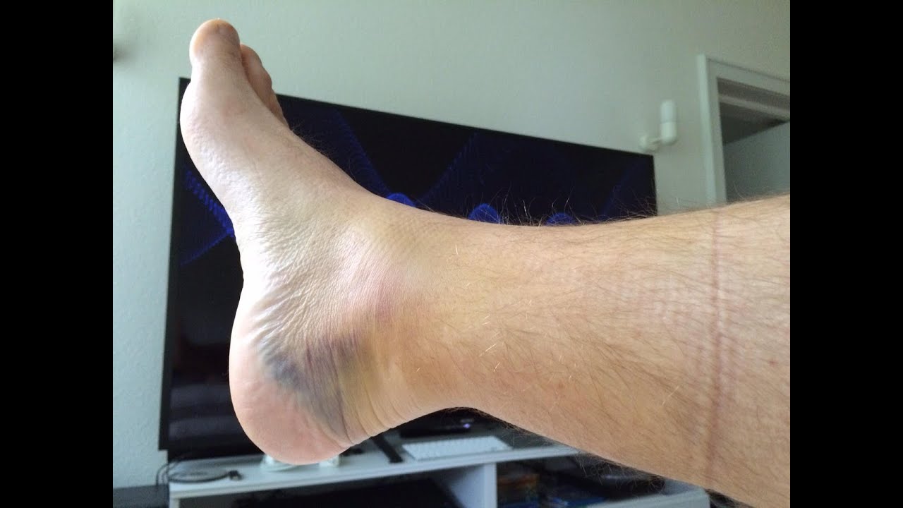 Achilles Tendon Recovery #1-non-surgical, early weight bearing option