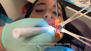 Buccal Fat Removal at The Spiegel Center