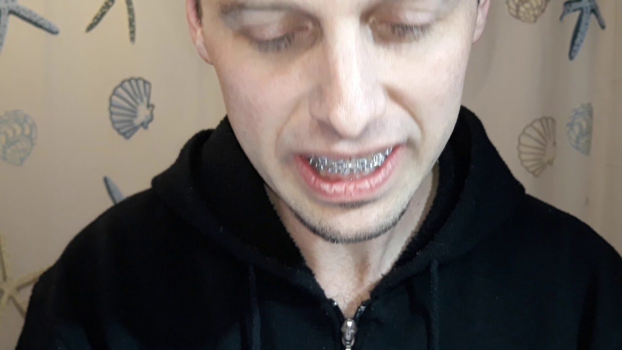 Watch Now Elastici apparecchio ortodontico Elastici apparecchio ortodontico