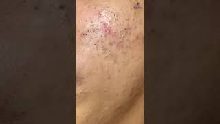 Download lagu Full Face Before Acne Treatment at Ga Spa #shorts mp3