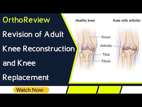 OrthoReview - Revision of Adult Knee Reconstruction and Knee Replacement for Orthopaedic Exams
