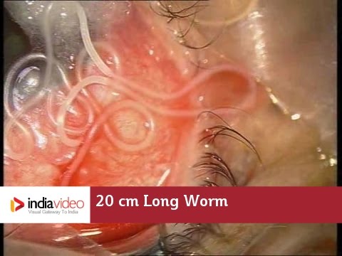 Rengeteg pinworm van a testben