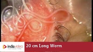 Surgical removal of 20 cm long worm in the human eye, first ever recorded on video 