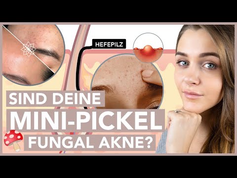 Fungal Akne - So wirst Du sie sofort los