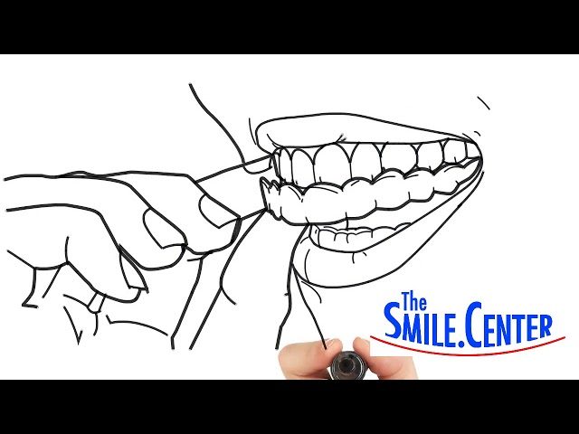 See Why Short-Term Orthodontics Are Popular