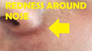 how to get rid of redness around nose crease