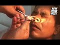 Doctor Pulls Gigantic Leech from Man’s Nose | New York Post