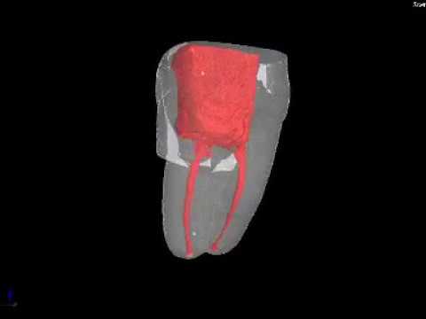 VDW Dental · Kanalverlauf vor und nach der Instrumentierung mit RECIPROC (klinisches Video)