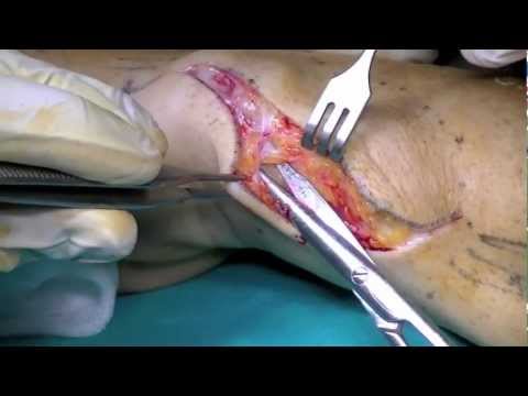 Come raddrizzare il finger joint Mal di vita posteriore destra