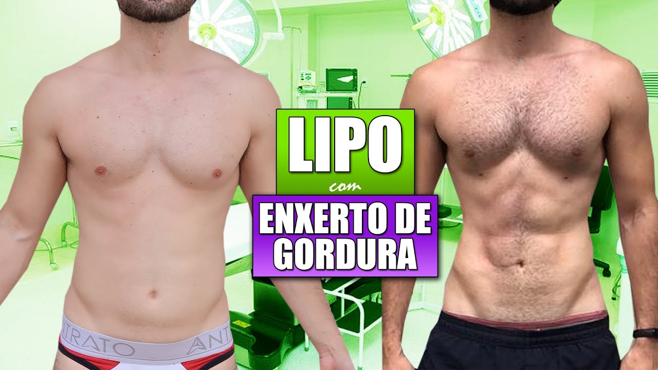 Watch Now ANTES E DEPOIS DA LIPOESCULTURA COM ENXERTO NO PEITORAL | CIRURGIA PLÁSTICA ANTES E DEPOIS DA LIPOESCULTURA COM ENXERTO NO PEITORAL | CIRURGIA PLÁSTICA