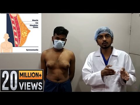 Grade 3 Gynecomastia its diagnosis and treatment | Learn Everything About Male Chest Reduction