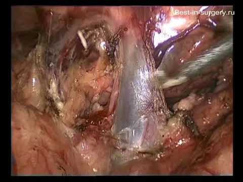 Laparoscopic adrenalectomy - laparoscopic operations, laparoscopy [Video]