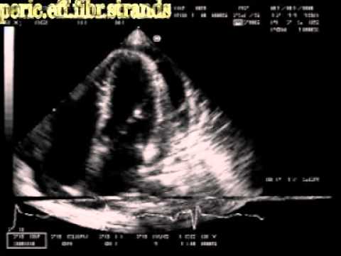 Pericardial effusion with fibrinous strands