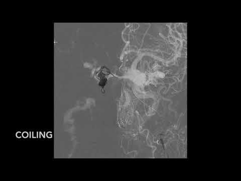 DAVF sincav through facial veins