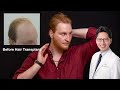 Is 24 Too Young to Have a Hair Transplant? | Client Case Study - Rhys | Dr Mark Tam