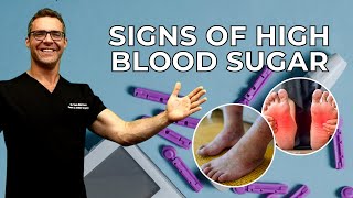 Download lagu Top 10 Signs of High Blood Sugar & Diabetes! mp3 Download lagu Top 10 Signs of High Blood Sugar & Diabetes! mp3