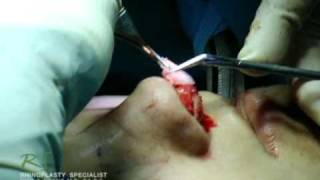 OR Video Footage: Live Revision Rhinoplasty