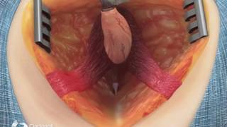 Posterior Surgical Repair of Bulbar Urethral Fistula | Cincinnati Children&#39;s