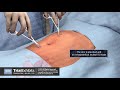 Patient Preparation for Laparoscopic Hysterectomy