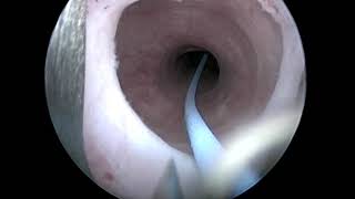 Incisione endoscopica stenosi uretra