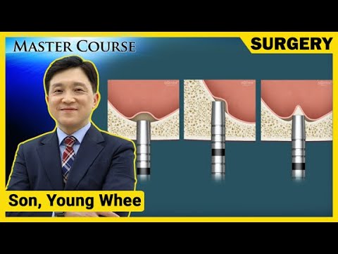 [Master Course Season2 - SURGERY] Sinus Floor Elevation - Crestal Approach(Osteotome)