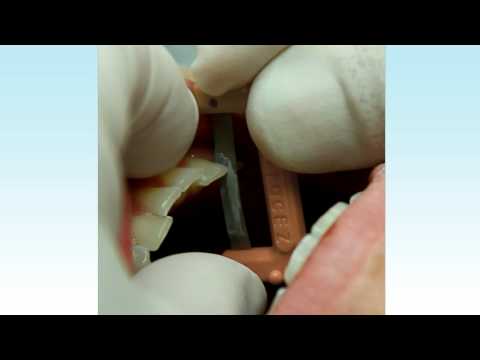 ContacEZ - IPR Optional Strips