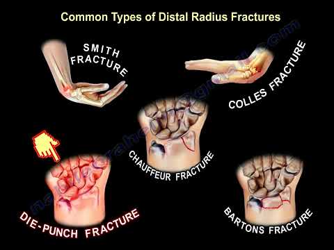 wrist fractures, symptoms, examination, diagnosis and treatment.