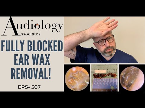 FULLY BLOCKED  EAR WAX REMOVAL - EP507