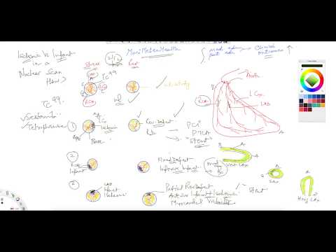 ^MuniSTHealth - #223 How To Tell Ischemia vs. Infarct On Nuclear Scan?