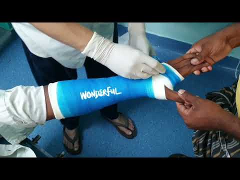 Closed reduction | Minimally displaced fracture Lower end Radius | Fiberglass plaster | Adamya Hosp
